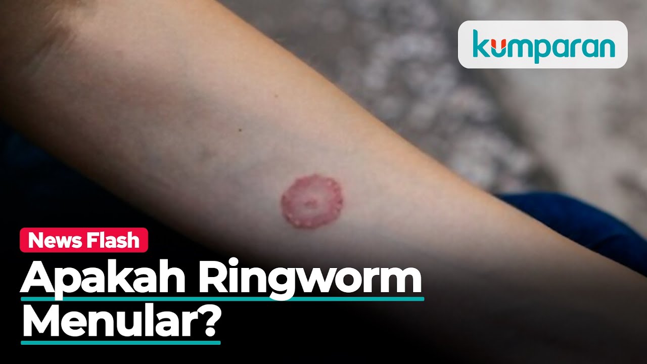 Apa Itu Ringworm? Kenali Gejala dan Penyebabnya!