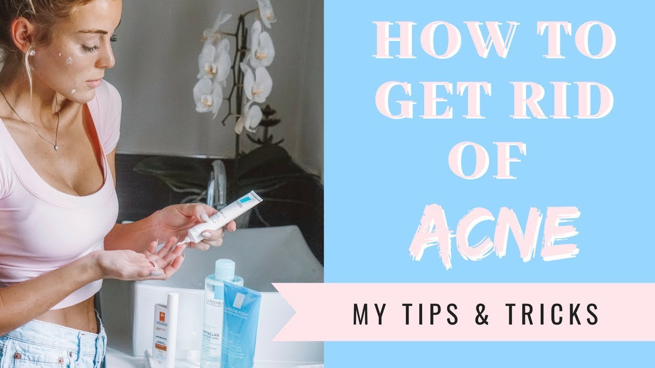 How to Get Rid Of Acne |  My Tips & Tricks