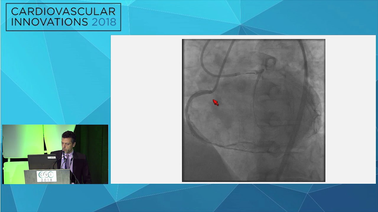 CVI2018 Session: Microcatheter entrapment - Wissam Jaber, MD