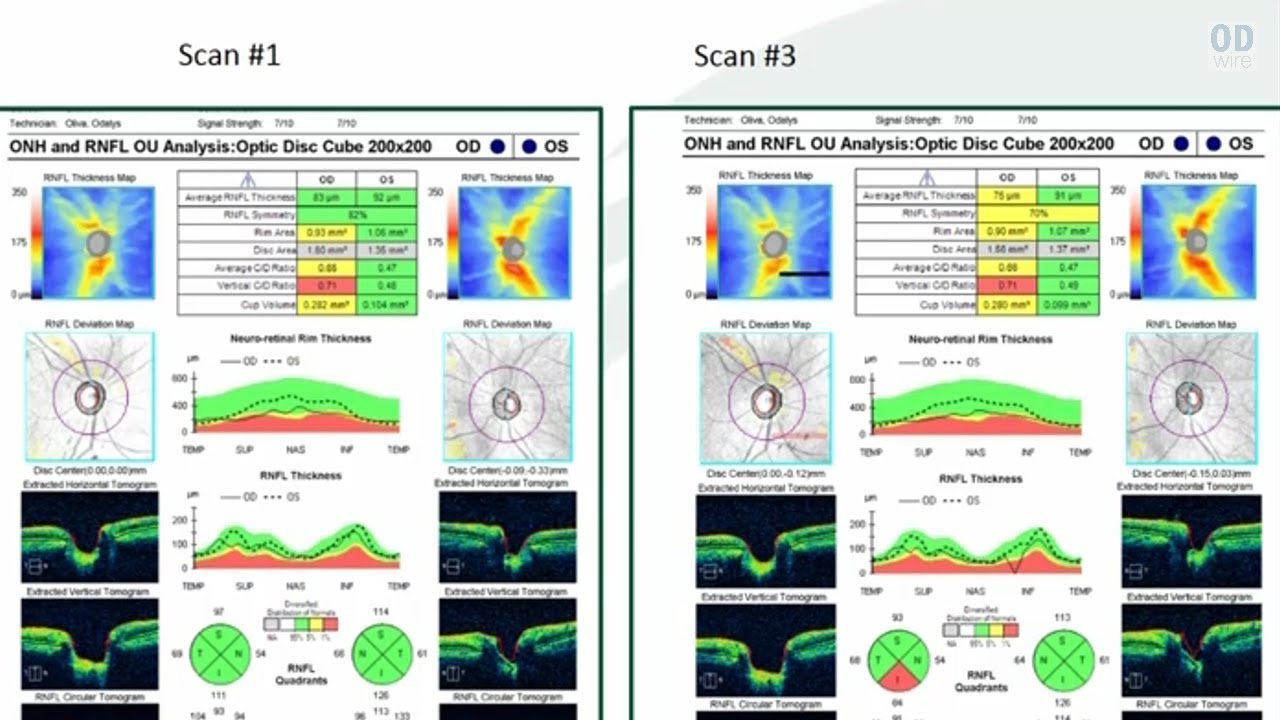 10 Hacks for OCT Interpretation in Glaucoma - Dr. Mark Dunbar