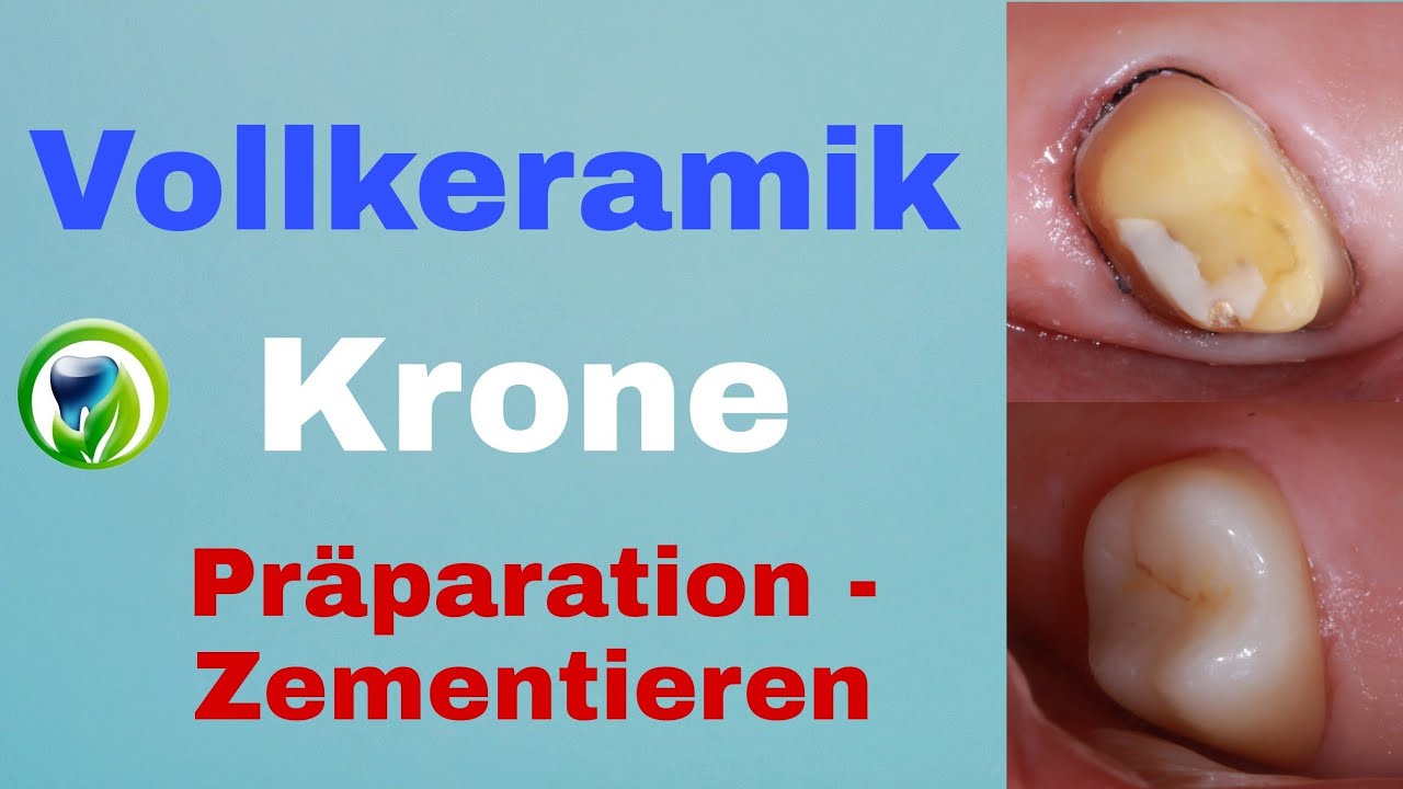 Vollkeramik-Krone im Seitenzahnbereich | Patientenfall,  Pr&auml;paration, Einsetzen