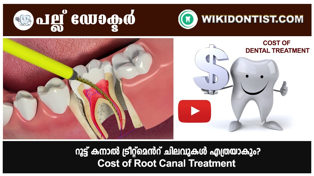 റൂട്ട് കനാൽ ട്രീറ്റ്മെൻറ് ചിലവുകൾ എത്രയാകും/Cost of Root Canal Treatment/Dr.Thomas Nechupadam