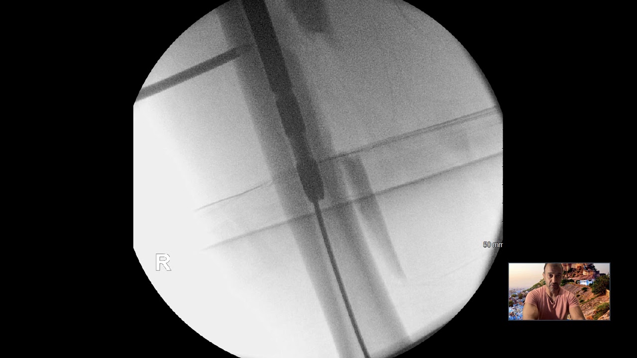 Femoral nailing tips in 6 minutes with Jai Rawal