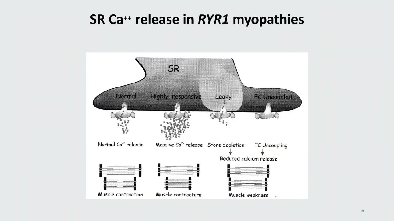 Bleeding Abnormalities in Women with RYR-1-Related Disorders