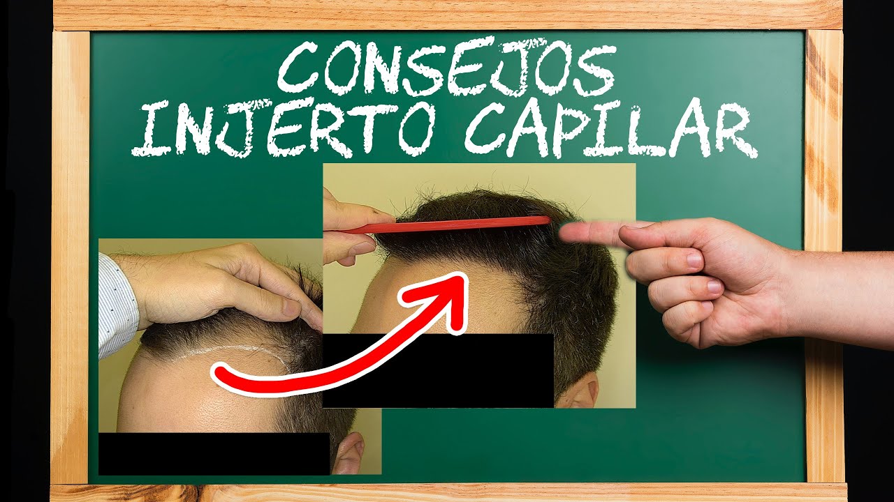 CONSEJOS INJERTO de PELO por CIRUJANO