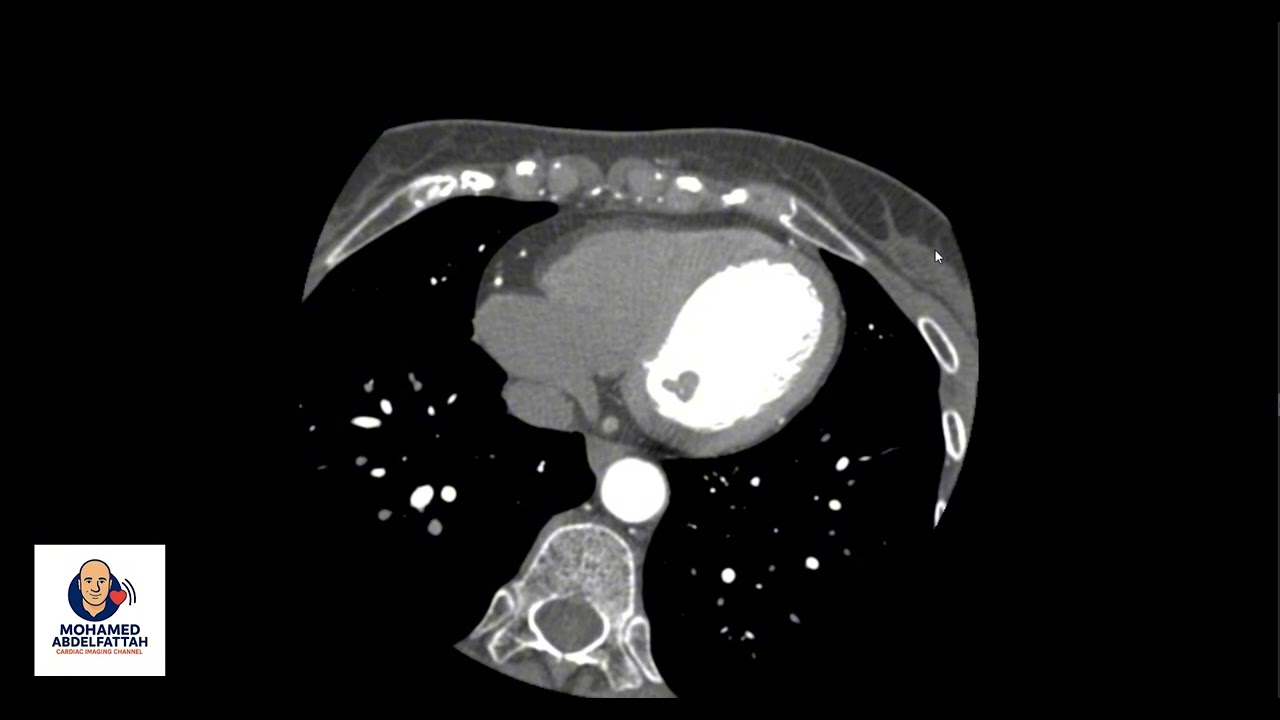 RV fat infiltration ≠ ARVC.