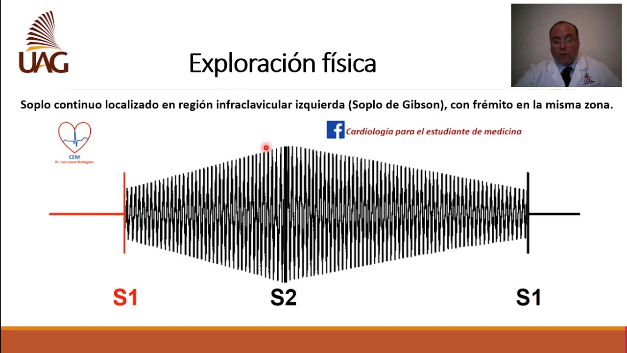 Persistencia del conducto arterioso