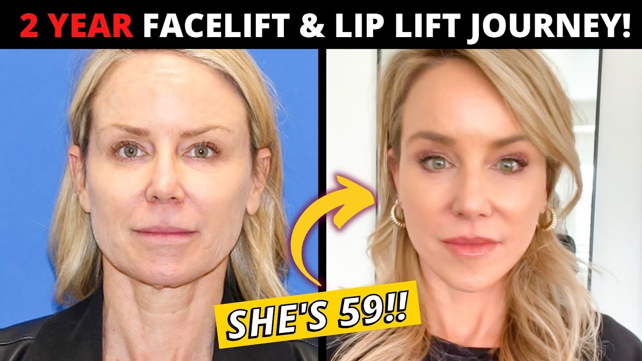 59 Year Old's 2 Year Facelift and Lip Lift Journey (her entire post-op recovery!)