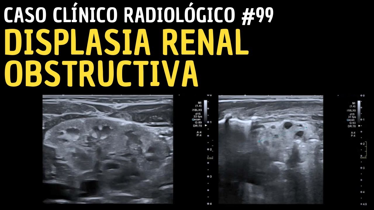 Caso clínico 99: Displasia renal obstructiva.