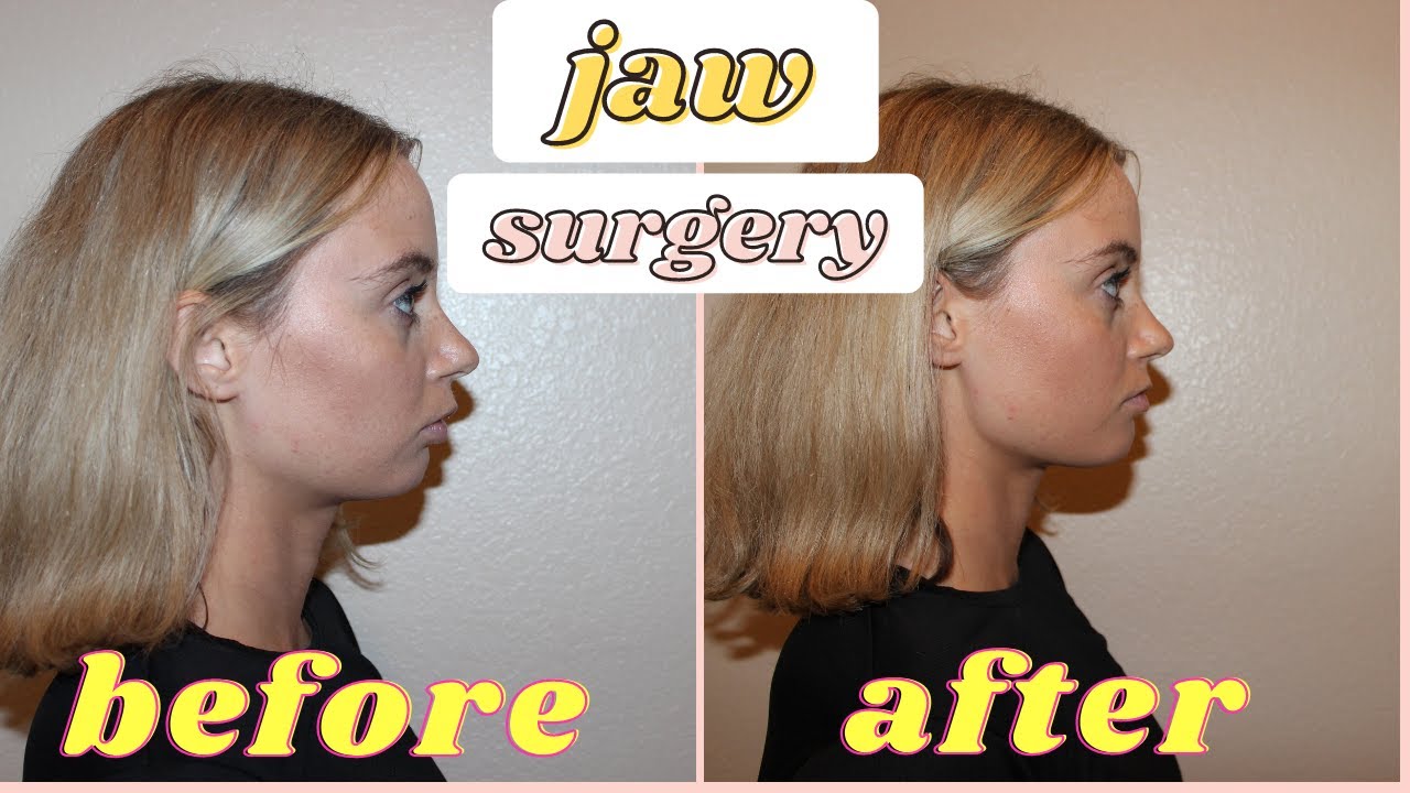 I need jaw surgery... (cost, insurance, timeline)