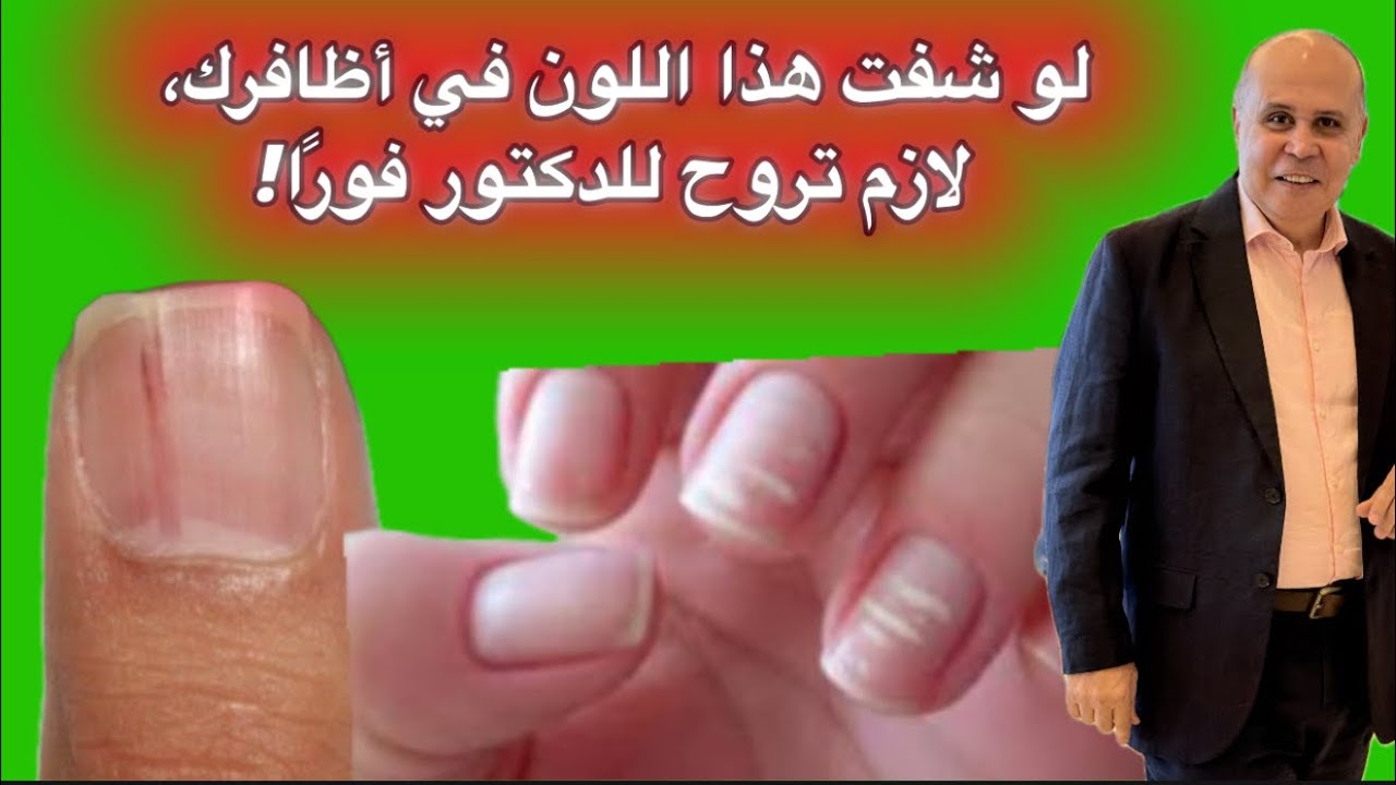 راقب أظافرك ..إشارات خطيرة لا تتجاهلها 💅⚠️”لونها قد ينذرك بمرض خطير