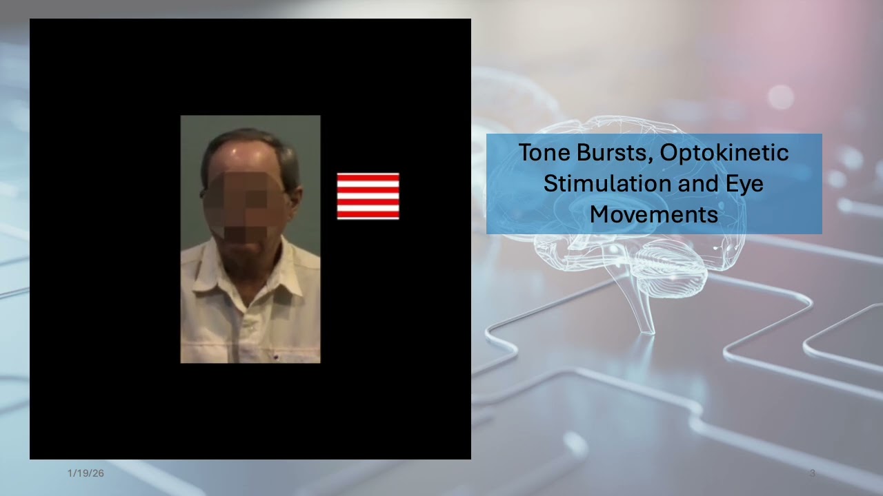 Tone Burst Neuromodulation for relief of Cervical Dystonia