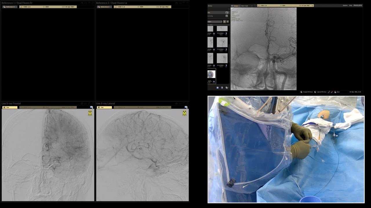 Case-3, ICA aneurysm, 04-03-2026