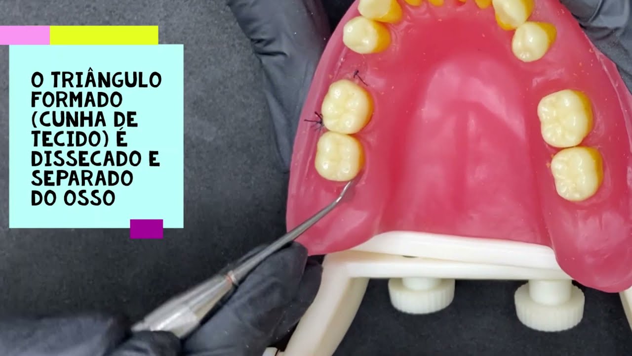 Cirurgia Periodontal - Cunha Distal