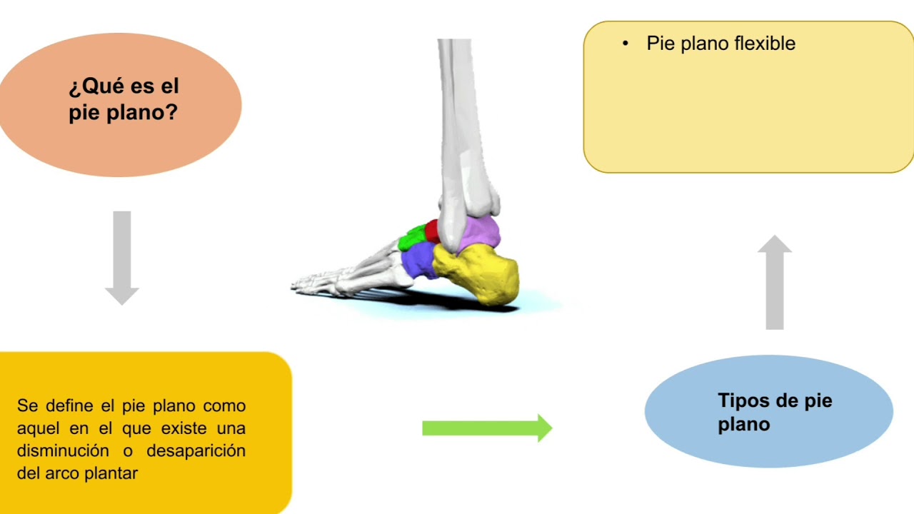 MITOS, REALIDADES Y EJERCICIOS FISIOTERAPEUTICOS DEL PIE PLANO.