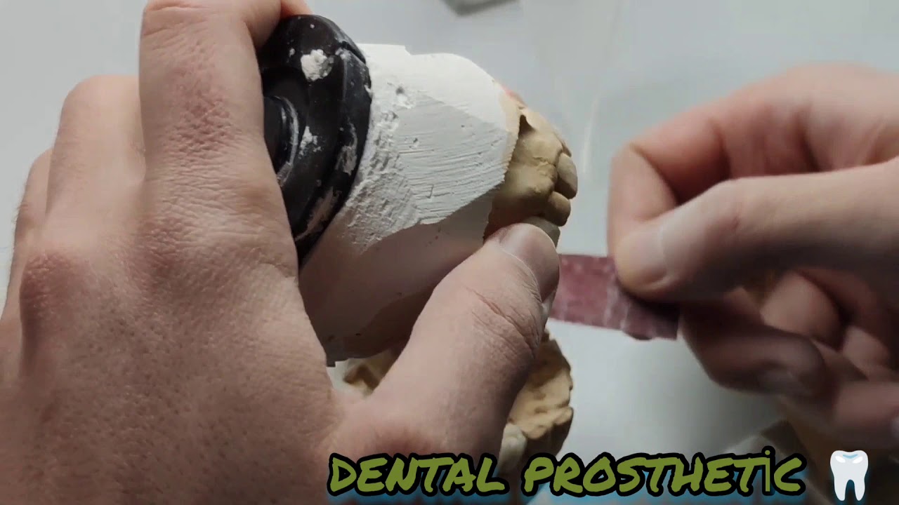 HASTA AĞZINA TAKİLMADAN ÖNCE İMPLANT ÜSTÜ PORSELEN TESVİYESİ..!