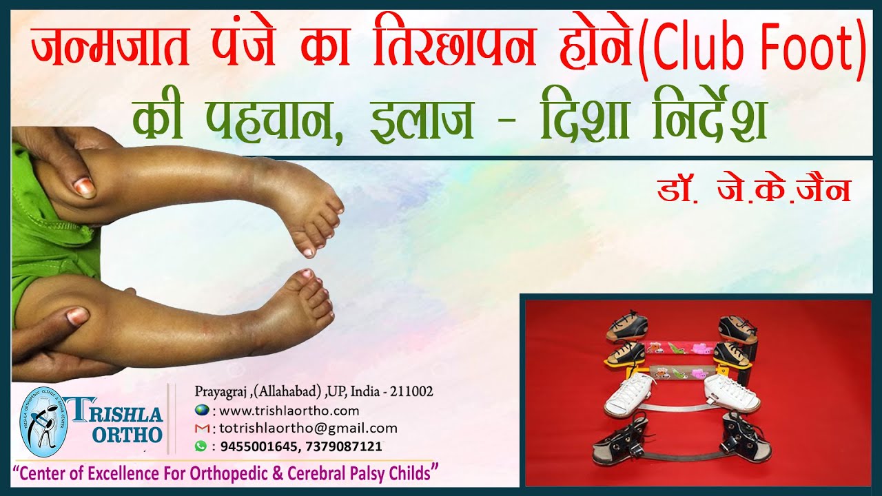 क्लब फुट (CTEV): जन्मजात पंजे का तिरछापन होने की पहचान, इलाज & दिशा निर्देश Dr. J K Jain