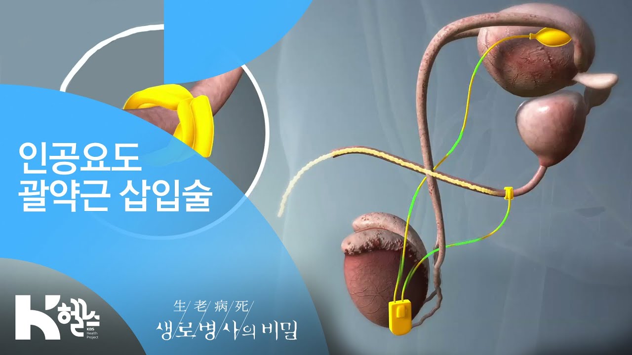 인공요도 괄약근 삽입술 - (20190130_681회 방송) 쉬쉬하다 내가 키운 고통, 배뇨장애