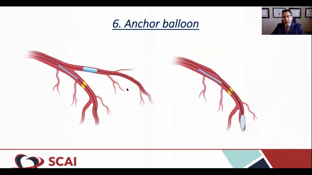 #SCAI2021 - Ups & Downs of #Coronary #Tortuosity: Uncomplicating the complex - Hady Lichaa, MD