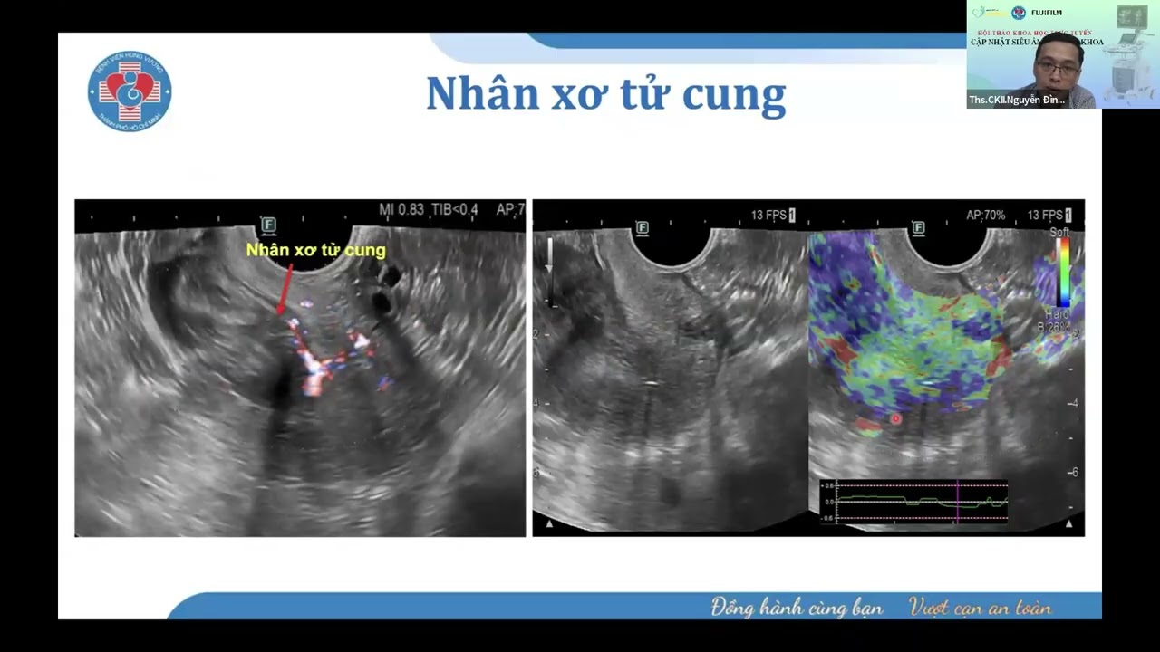 Siêu âm đàn hồi mô trong phụ khoa
