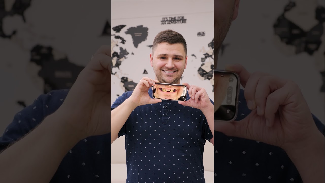 Smile Makeover Before and After Izmir, Turkey | Dentkm Gaziemir Dental Clinic