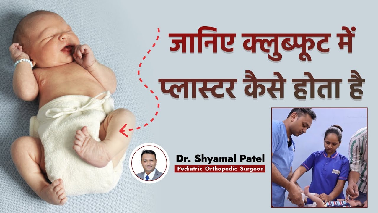 क्लुब्फूट में प्लास्टर कैसे होता है | Clubfoot Treatment | Casting of a Child With Clubfoot