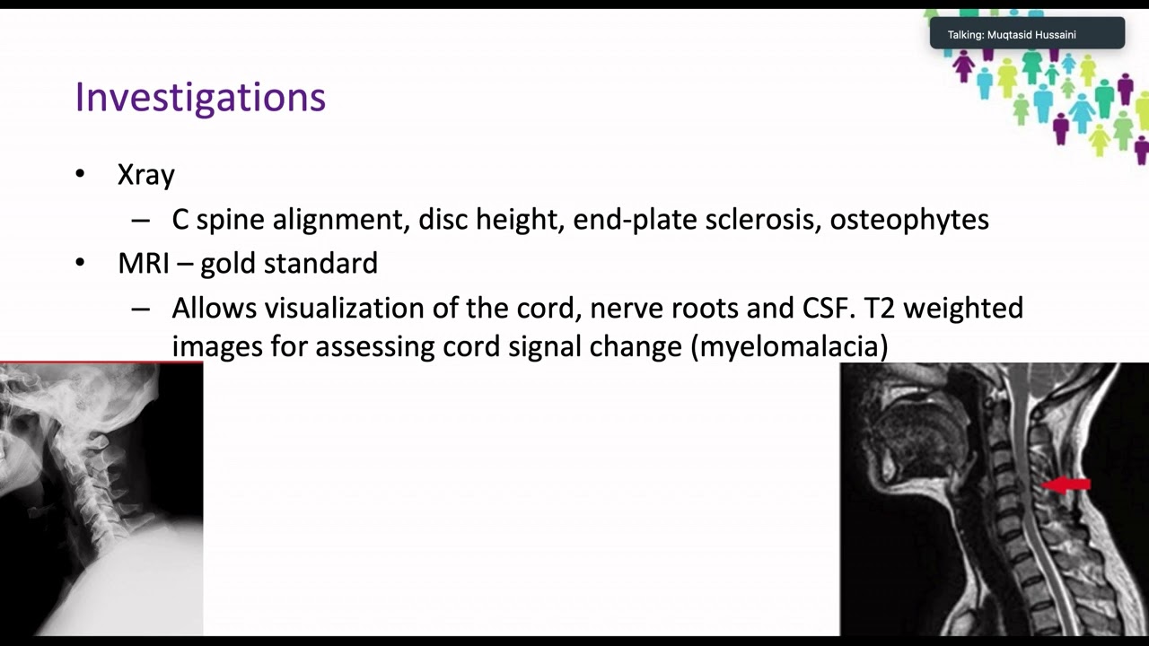 OrthoFracs Degenerative Cervical Myelopathy by Dr Muqtasid Hussaini