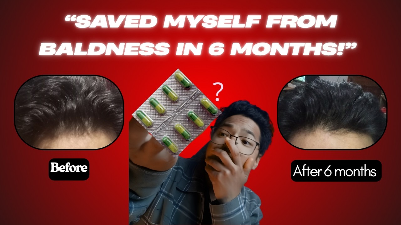 How I Saved Myself From Balding in 6 Months. Complete Beginner Guide for AGA