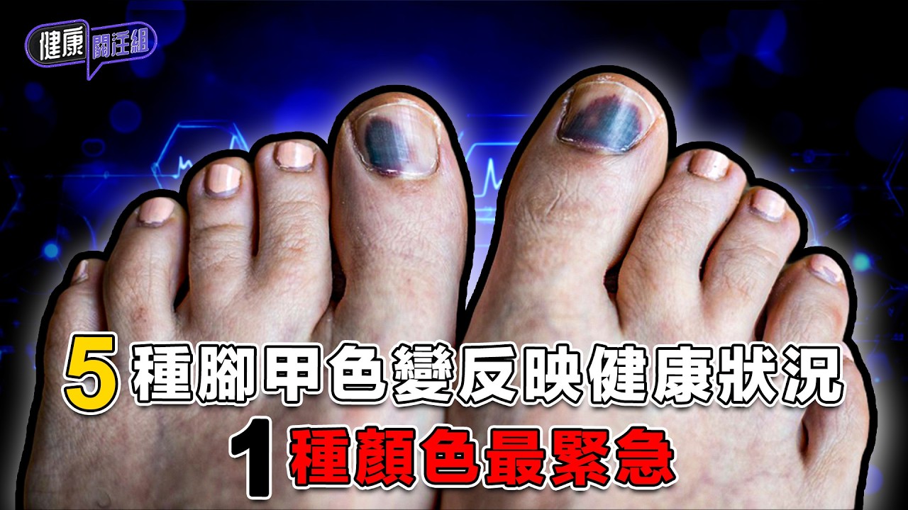 5種腳甲色變反映健康狀況 1種顏色最緊急 ｜ 健康關注組 ｜ EP527 ｜ 腳甲變色 ｜ 黑甲症 ｜ 皮膚癌 ｜ 黑色素瘤 ｜ 灰甲 ｜ 敖嘉年 ｜ 朱智賢 ｜ HOY TV 77台