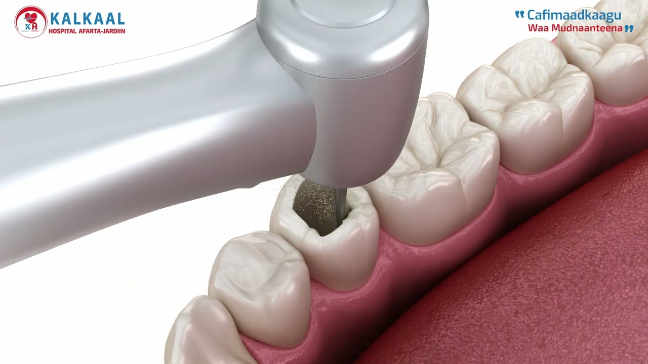 Kalkaal Dental Center Mogadishu | Implants, Braces, Root Canal, Emergency Care