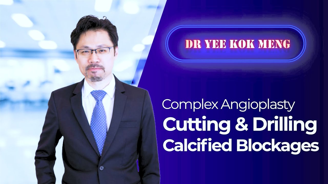 Complex Angioplasty - Cutting & Drilling Calcified Blockages
