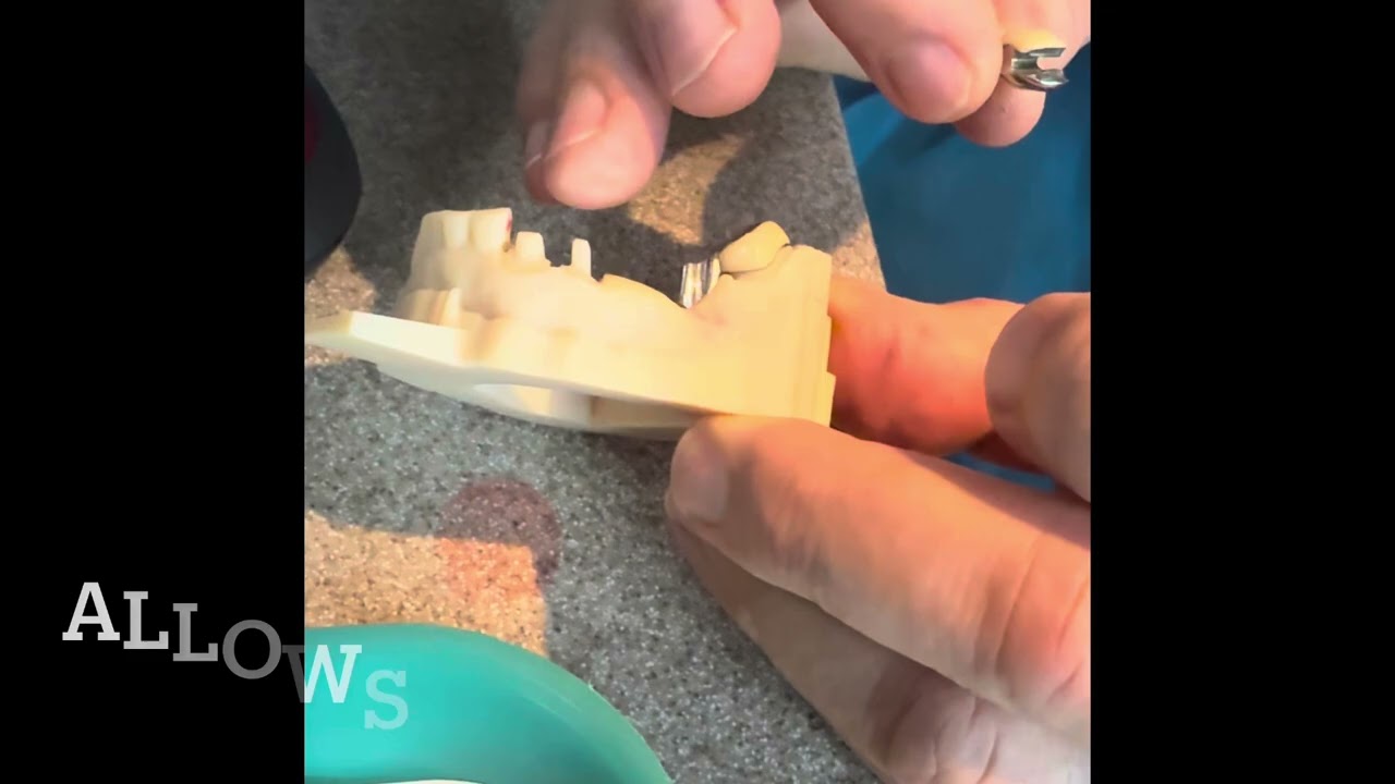 Stress breaker dental Bridge