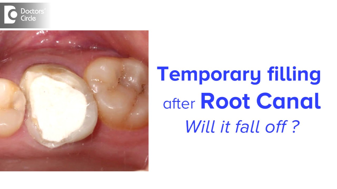 How long can you keep a temporary filling after root canal? - Dr. Chandan Mahesh