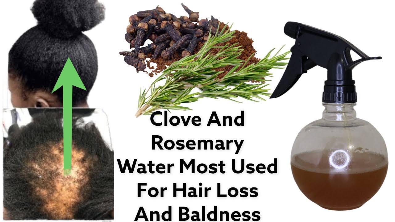 Clove Water, And Rosemary, STOP Hair Loss, Spray 2 Times A Day Accelerate Hair Growth From Alopecia