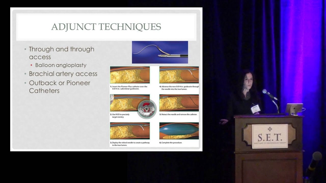 Endovascular Management of Aorto-Iliac Occlusive Disease