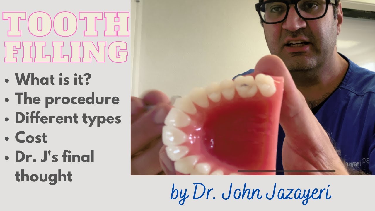 Tooth Fillings: Cost + Process + Silver vs. White