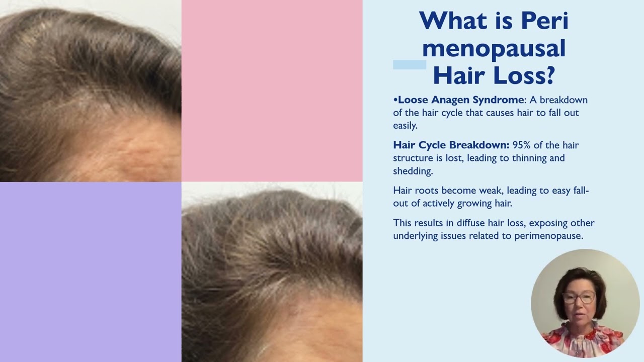 Menopause Health   Perimenopause Hair Loss