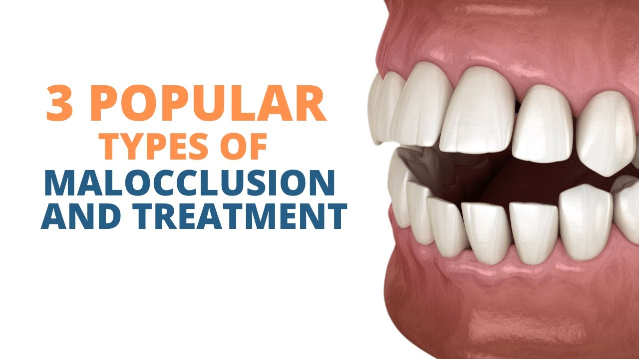 3 Popular Types of Malocclusion and How to Prevent them
