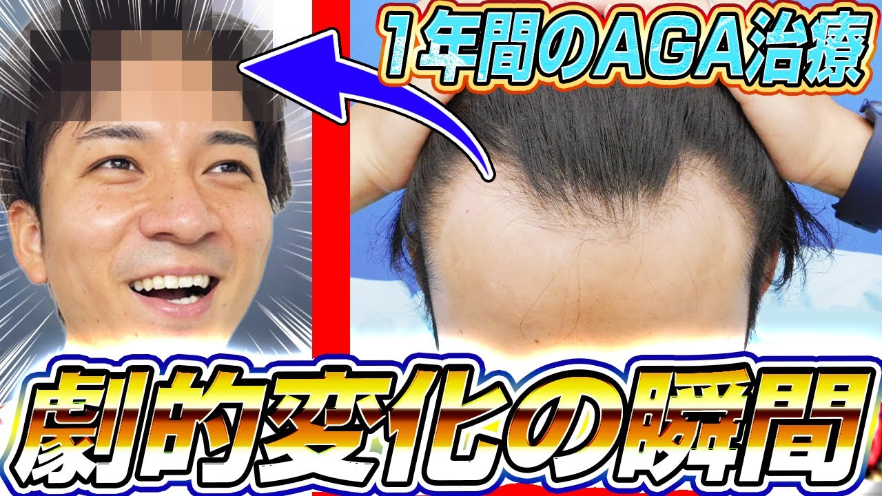 【AGA治療結果発表】よしきの1年間の軌跡をご覧ください