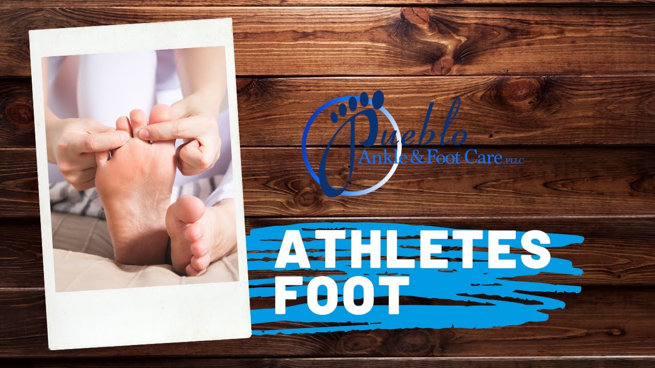 Athletes Foot (Tinea Pedis) | Benjamin Marble DPM