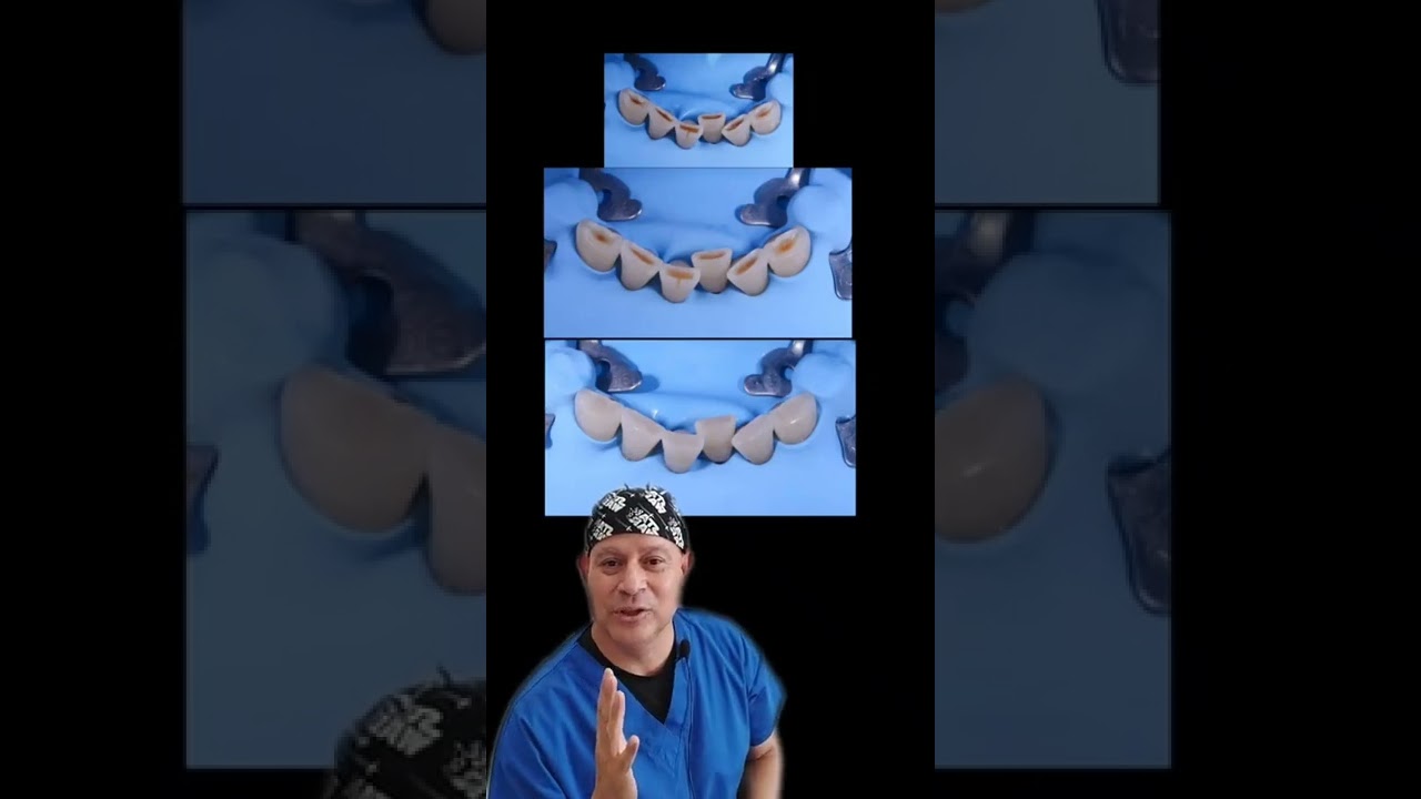 TIENES DESGASTE DENTAL PIGMENTADO? #shorts #dentista #sonrisa