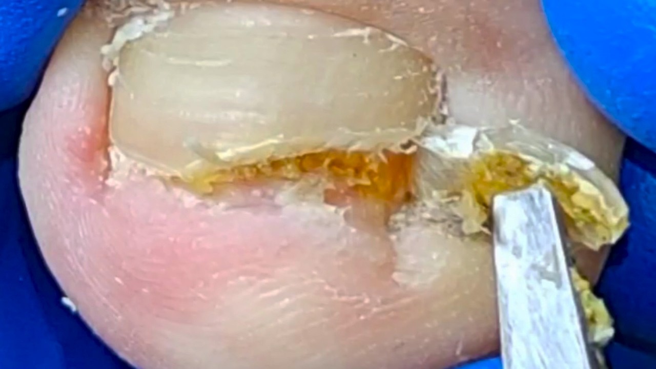 ¡Trozos enormes de uñas mal cortadas! Onicomicosis