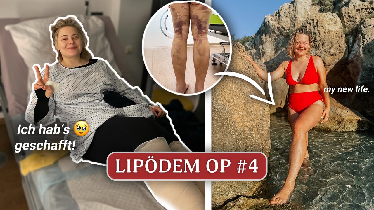 Meine LETZTE Lipödem OP! 🥹 Bis 7 Monate danach! 👀 OP #4 | #DominoKati
