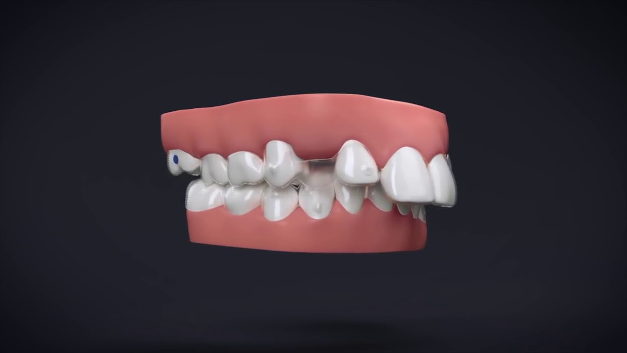 Invisalign® Treatment with Manidublar Advancement