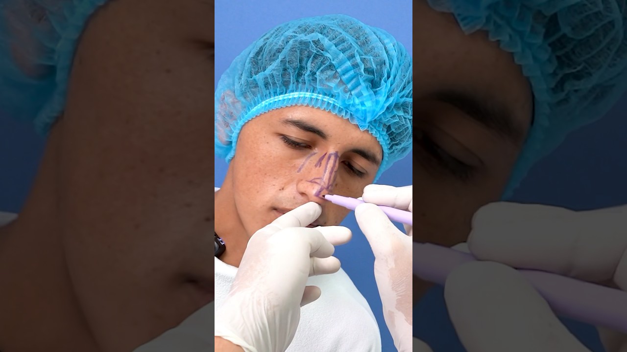 &iquest;Qu&eacute; tal? Mejoramos el dorso y la punta nasal, para darle armon&iacute;a y simetr&iacute;a.