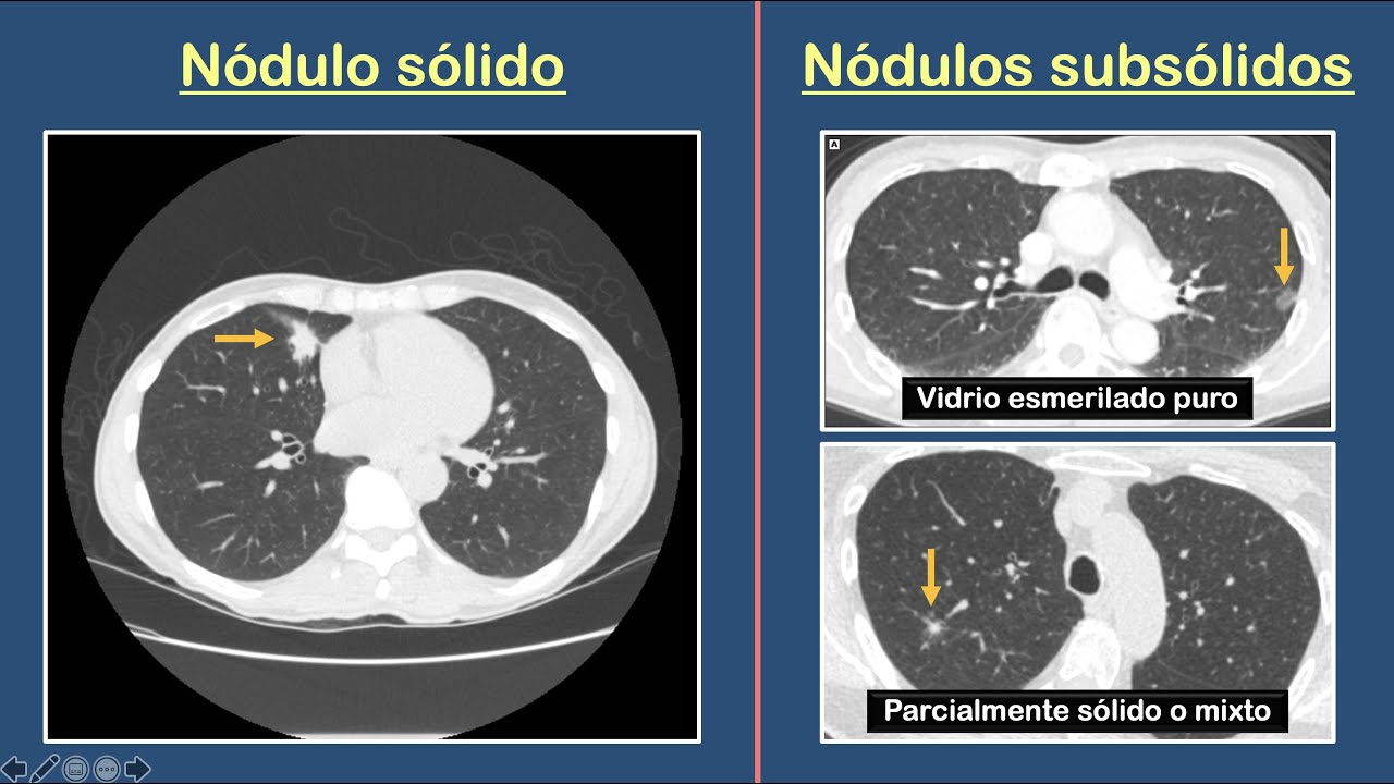 Nódulo Pulmonar Solitario