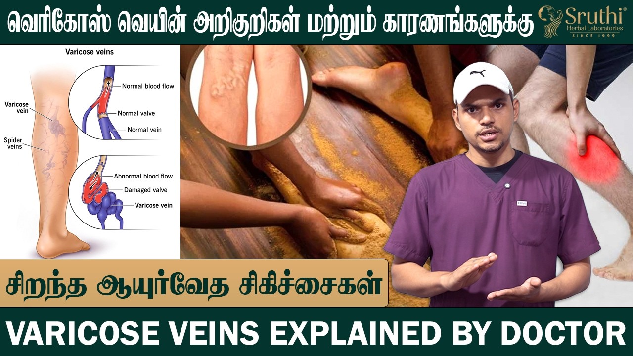 90% பேர் தெரியாம இந்த தவறு பண்றாங்க! Varicose Veins வர காரணம் இதான்! Doctor Explained
