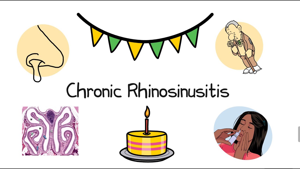 Chronic Rhinosinusitis - FRCS ENT Exam Essentials (1 year anniversary video!!🥳)