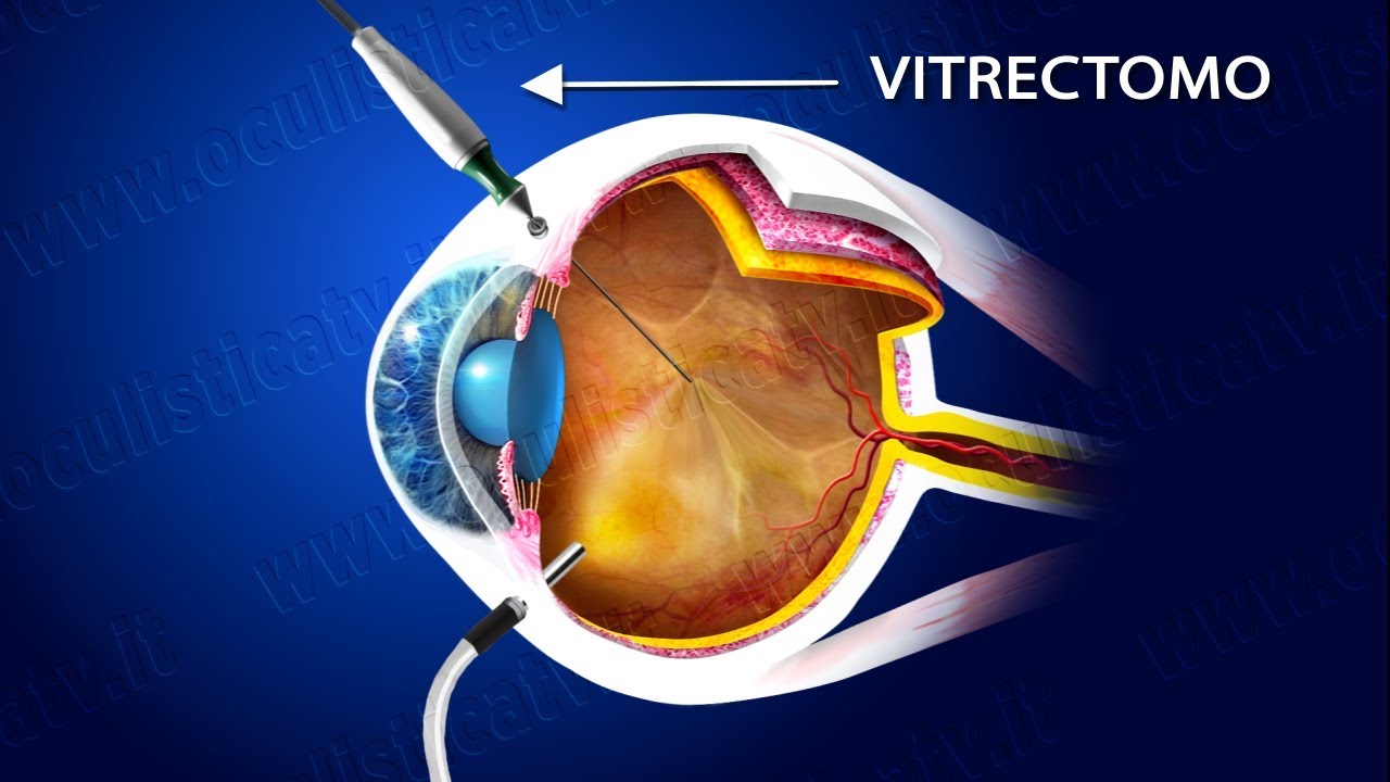 Retinopatia diabetica proliferante terapia laser e chirurgica