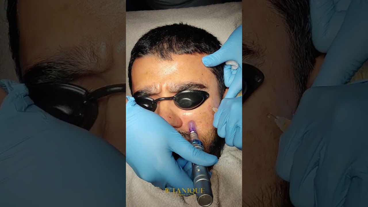 Acne Scars and Open Pores treatment | D'Tanique | Premium Clinic | Ahmedabad